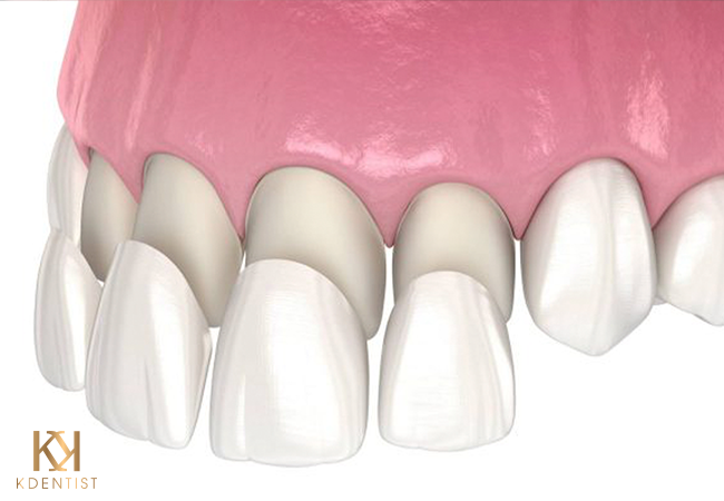 Khái niệm dán sứ Veneer