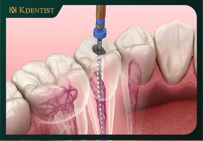 Khái niệm về chữa tủy răng