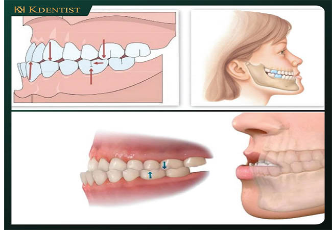Dịch vụ niềng răng tại Quy Nhơn