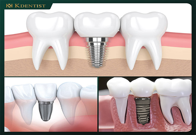Trồng răng implant