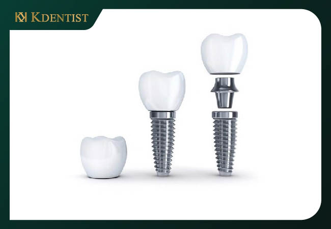 Nguồn góc xuất sứ của răng implant hàn quốc