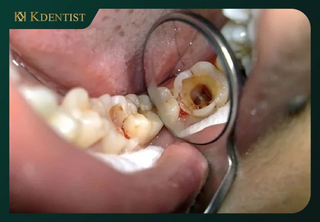Điều trị chữa tủy răng bao lâu thì hết đau Bị chết tủy răng