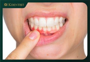 Tránh vận động hàm răng mạnh Tránh vận động hàm răng mạnh