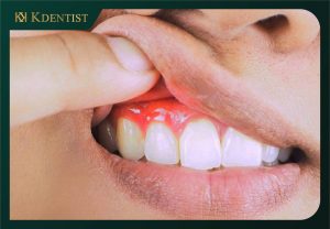 Tóp 9+ cách chăm sóc răng sau khi cắm implant Tóp 9+ cách chăm sóc răng sau khi cắm implant