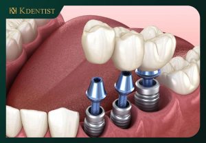 Loại trụ implant được sử dụng Loại trụ implant được sử dụng