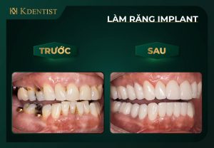 Có nên trồng răng implant không? Có nên trồng răng implant không?