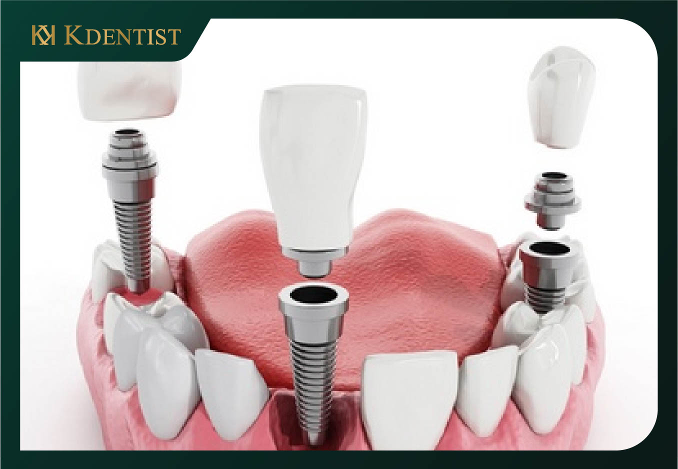 trồng răng implant mất bao lâu