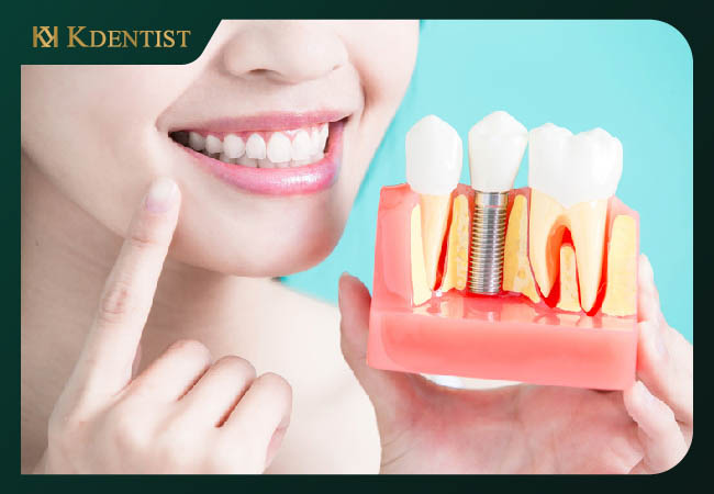 Trồng răng implant mất bao lâu Trồng răng implant mất bao lâu