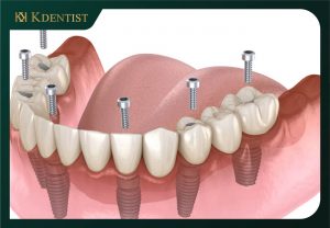 Cấy ghép răng implant toàn hoàn all on 6 Cấy ghép răng implant toàn hoàn all on 6