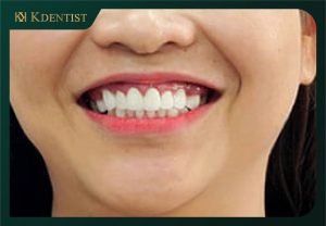Ưu điểm cấy ghép implant toàn hàm Ưu điểm cấy ghép implant toàn hàm