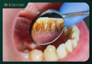 Dịch vụ cạo vôi răng Quảng Ngãi của HH DENTAL Dịch vụ cạo vôi răng Quảng Ngãi của HH DENTAL