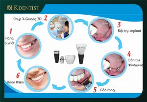 Quy trình cấy ghép implant nguyên hàm Quy trình cấy ghép implant nguyên hàm