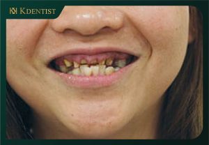 Nhược điểm cắm implant toàn hàm Nhược điểm cắm implant toàn hàm