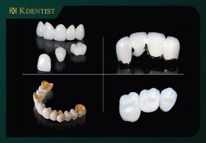 Lấy dấu răng để thực hiện mão răng sứ. Lấy dấu răng để thực hiện mão răng sứ.