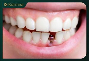 Phẩu thuật cắm trụ implant Phẩu thuật cắm trụ implant