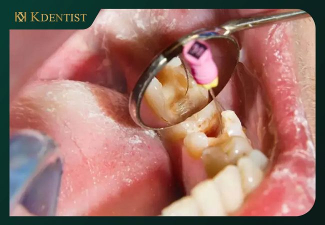 Điều trị chữa tủy răng cần bao nhiêu lần Giai đoạn điều trị lấy tủy răng