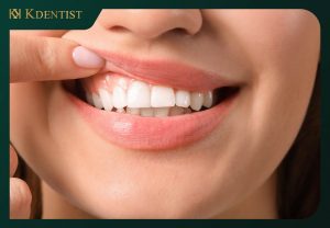 Điều trị viem nha chu Điều trị viem nha chu