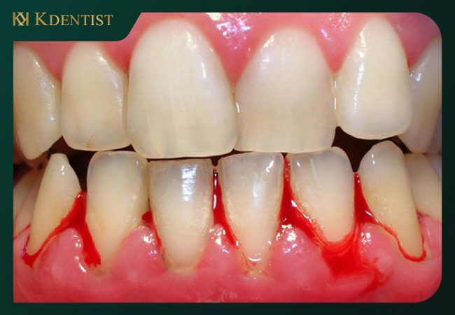 Các biến chứng khi phẩu thuật cười hở lợi không đúng cách Các biến chứng khi phẩu thuật cười hở lợi không đúng cách