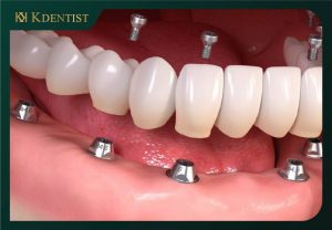 Các lý do cn62 phải tuần thủ sau khi cắm implant Các lý do cn62 phải tuần thủ sau khi cắm implant
