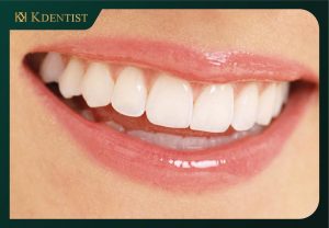 Những lưu ý sau khi cắm trụ implant Những lưu ý sau khi cắm trụ implant