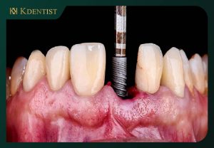 Cấy ghép sai lệch vị trí cần cắm implant Cấy ghép sai lệch vị trí cần cắm implant
