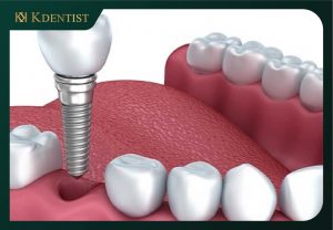 nhổ răng bao lâu thì cắm implant nhổ răng bao lâu thì cắm implant