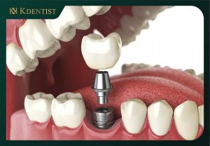 Sau khi nhổ răng > 4 tháng tiến hành cắm implant Sau khi nhổ răng > 4 tháng tiến hành cắm implant