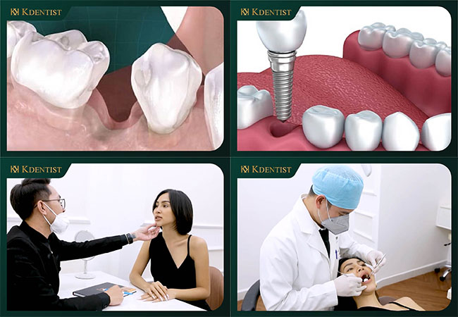 sau khi nhổ răng bao lâu thì trồng implant