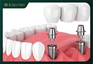 Sau khi nhổ răng 3 - 4 tháng tiến hành cấy ghép implant Sau khi nhổ răng 3 - 4 tháng tiến hành cấy ghép implant