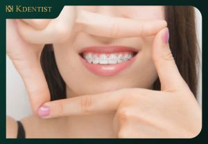20 tuổi có niềng răng được không 20 tuổi có niềng răng được không