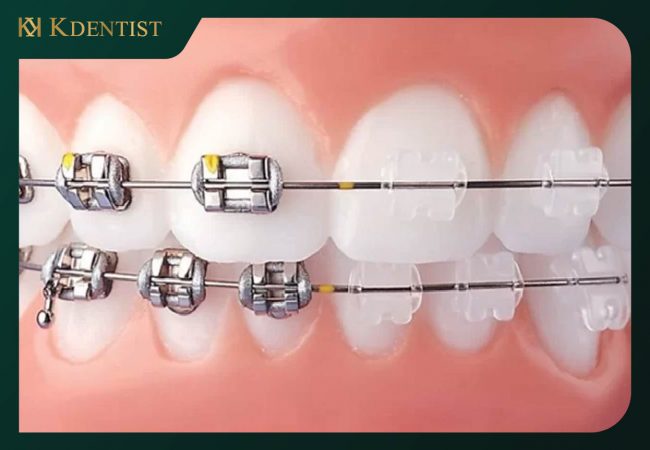 Niềng răng với mắc cài tự động Niềng răng với mắc cài tự động