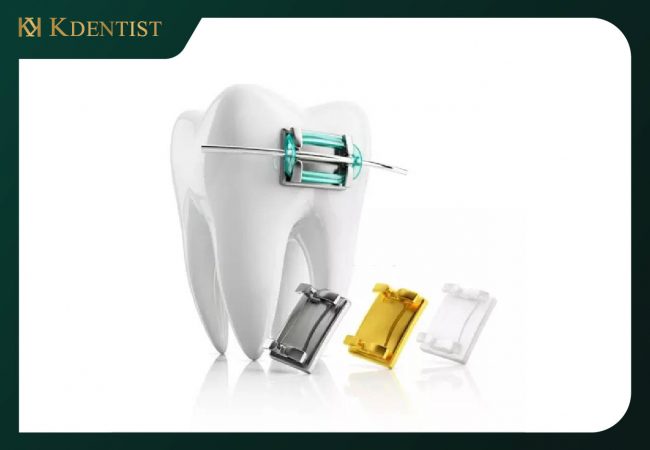 răng mắc cài sứ tự đóng răng mắc cài sứ tự đóng