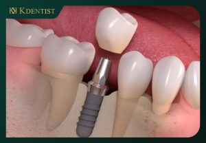 Tiến hành gắn mão sứ hoàn thành răng implant Tiến hành gắn mão sứ hoàn thành răng implant