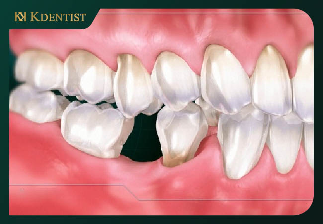 Yếu tố quan trọng quyết định thời gian cắm implant Yếu tố quan trọng quyết định thời gian cắm implant