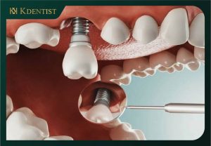 Sau khi nhổ răng tiến hành cấy ghép implant ngay Sau khi nhổ răng tiến hành cấy ghép implant ngay
