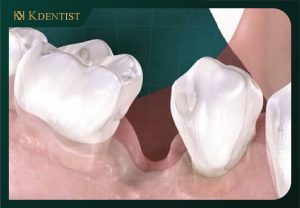 Sau khi nhổ răng bao lâu thì trồng implant được? Sau khi nhổ răng bao lâu thì trồng implant được?