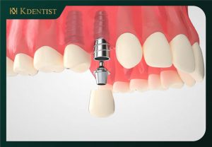 Sau khi nhổ răng 1 - 2 tháng tiến hành trồng implant Sau khi nhổ răng 1 - 2 tháng tiến hành trồng implant