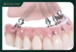 Các phương pháp trồng răng implant toàn hàm Các phương pháp trồng răng implant toàn hàm