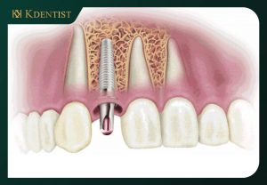 Tiến hành đặt trụ implant vào xương hàm Tiến hành đặt trụ implant vào xương hàm