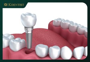 Khả năng chịu lực của trụ implant Khả năng chịu lực của trụ implant