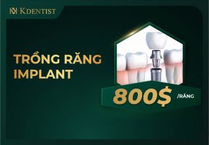 Giá trồng răng implant toàn hàm Giá trồng răng implant toàn hàm