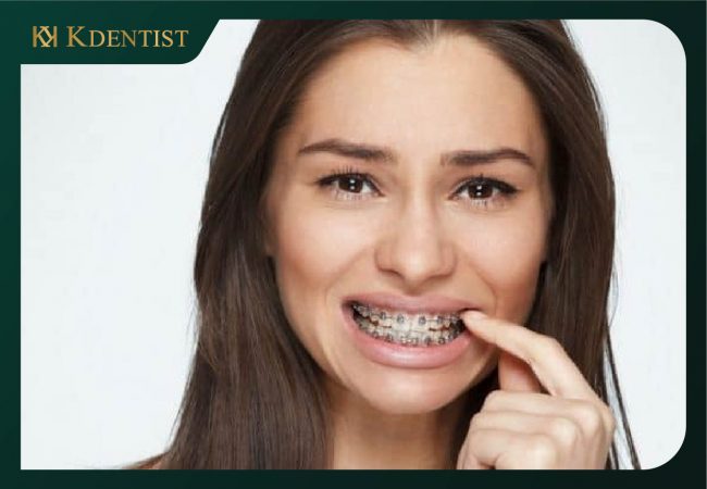 Độ tuổi lúc niềng răng Độ tuổi lúc niềng răng