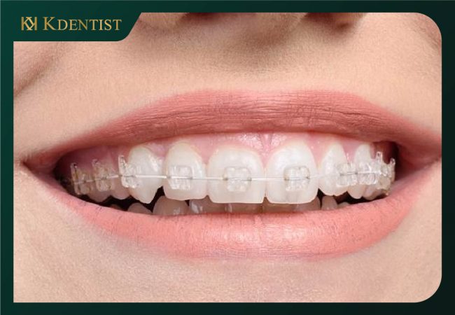 25 tuổi có niềng răng được không 25 tuổi có niềng răng được không