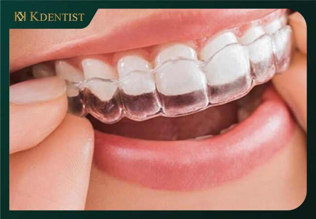 Niềng răng không mắc cài sử dụng khay nhựa Niềng răng không mắc cài sử dụng khay nhựa