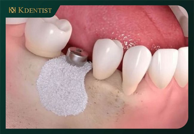 Trụ răng implant cấy trực tiếp vào xương hàm Trụ răng implant cấy trực tiếp vào xương hàm