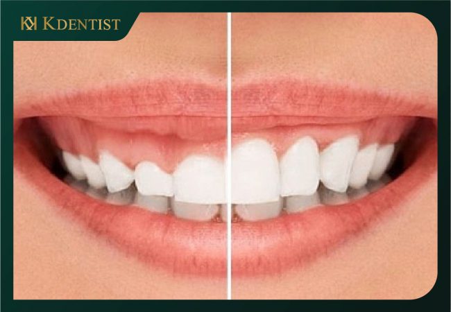 Phẩu thuật cắt nướu Phẩu thuật cắt nướu