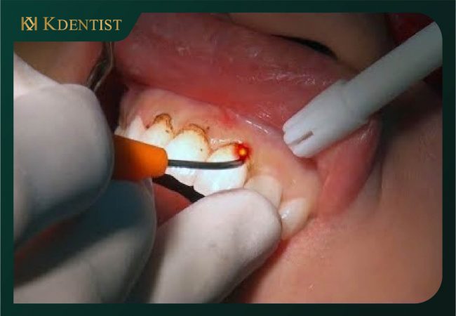 Phương pháp cắt lợi laser Phương pháp cắt lợi laser