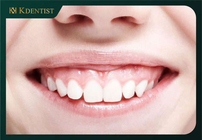 Điều trị cười hở lợi Điều trị cười hở lợi