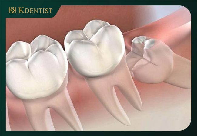 Các biểu hiện của lợi trùm lên răng Các biểu hiện của lợi trùm lên răng