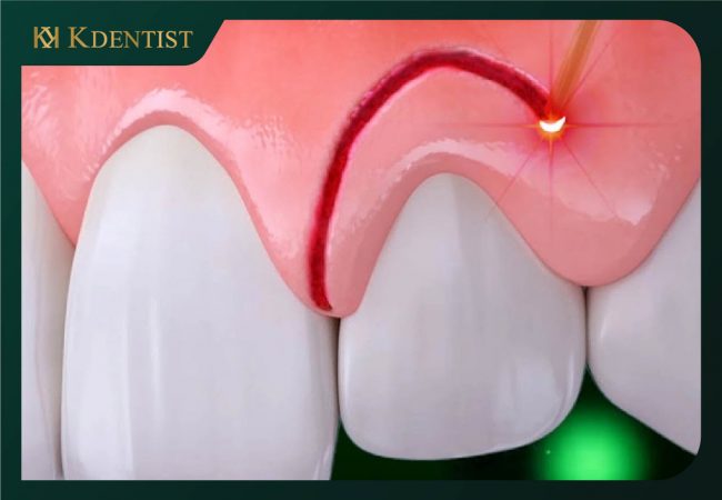 lưu ý sau khi phẫu thuật cắt lợi cần chỉnh xương ổ răng lưu ý sau khi phẫu thuật cắt lợi cần chỉnh xương ổ răng